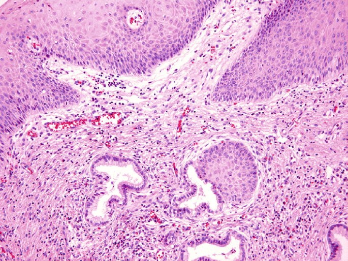 3.5 - Pathological Vaginal Discharge.pdf