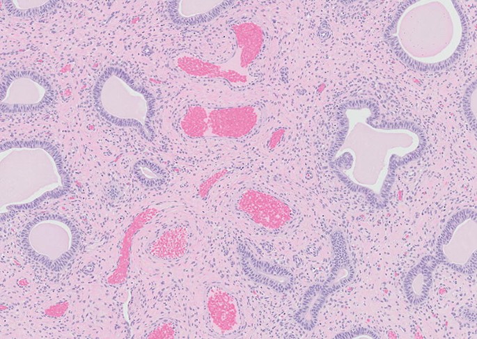 Gross image showing dilated and thick-walled blood vessels with