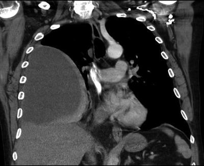 Thoracic Surgery: Surgical Procedures on the Chest and Thoracic