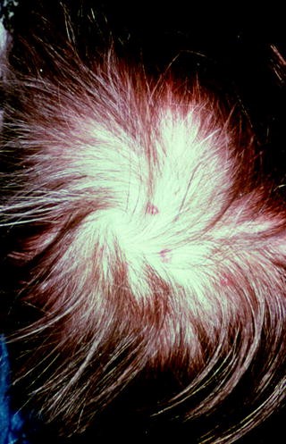 Von Hippel Lindau Syndrome Dermatological Features Springerlink