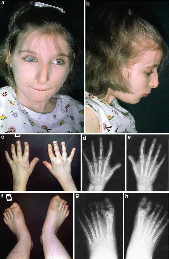 PDF) Rubinstein-Taybi syndrome: Dental manifestations and management