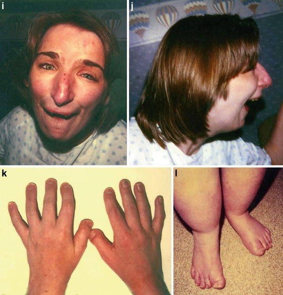 Rubinstein - Taybi Syndrome (Rubinstein syndrome, broad thumb