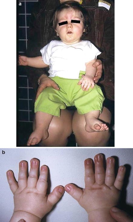 Figure 2. [Broad terminal phalanges (A) and broad, radially deviated thumbs  (B)]. - GeneReviews® - NCBI Bookshelf