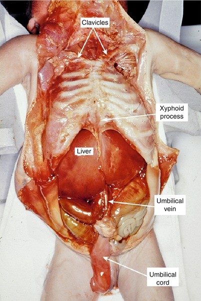 autopsy kid Child abuse syndrome – a forensic case of fatal impulsive act of violence