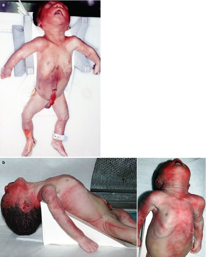 autopsy kid Pediatric Autopsy: Fetus, Newborn, and Child | SpringerLink