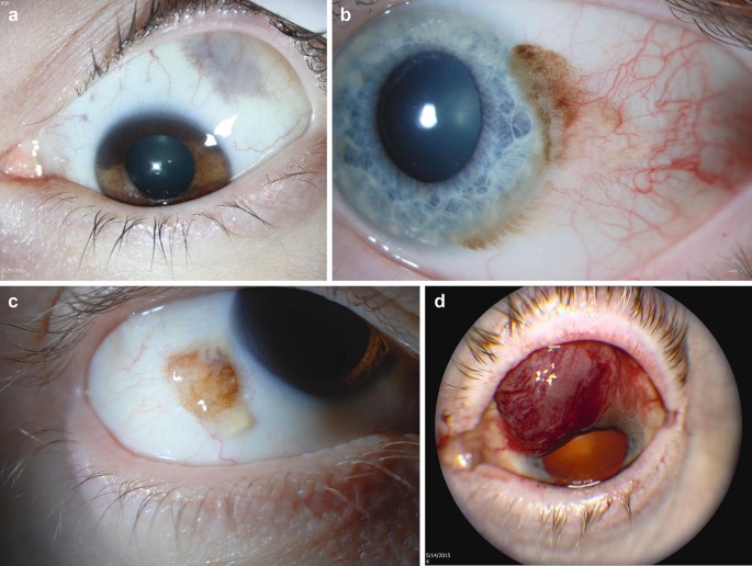 labial melanotic macule icd 10 Pathology Outlines