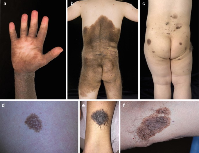 melanotic mass phenotype Congenital Melanocytic Naevi