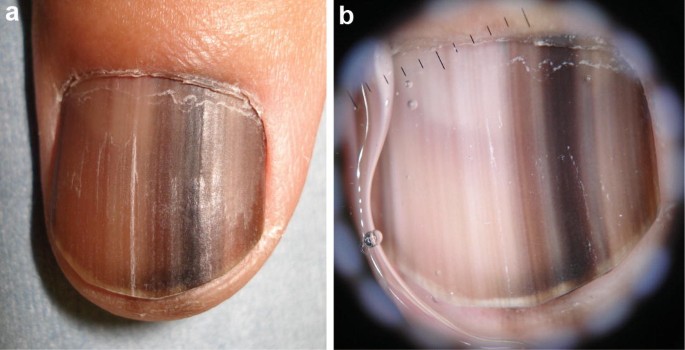nail pigment | Dermoscopy
