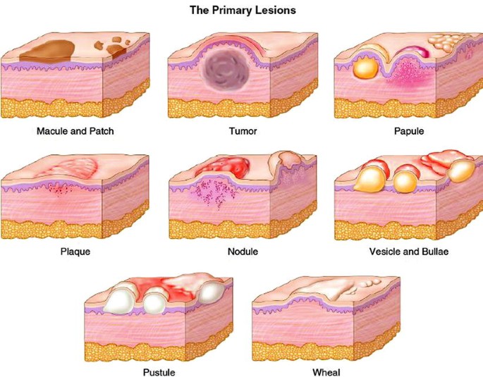 Glossary of Dermatological Terms | SpringerLink