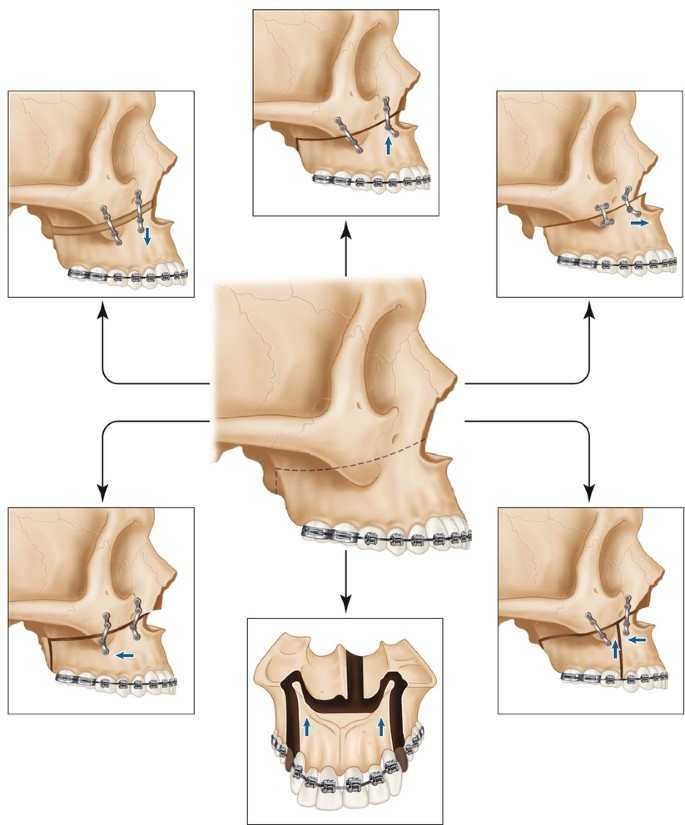 Maxillary Osteotomies | SpringerLink Maxillary Osteotomies | SpringerLink