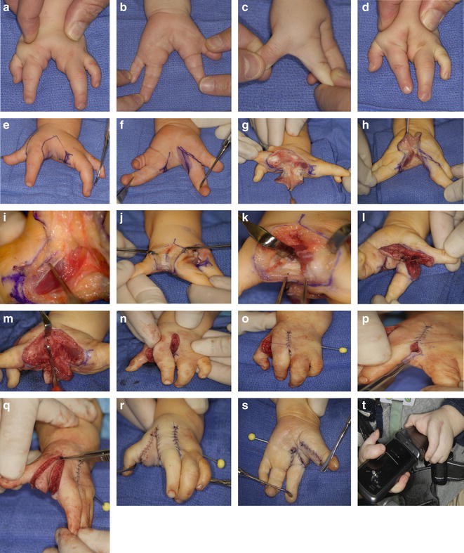 Deformities of Fingers and Toes in the Newborn