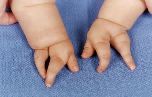 This TikTok Family With Brachydactyly, AKA Tiny Hands, Is A Breath