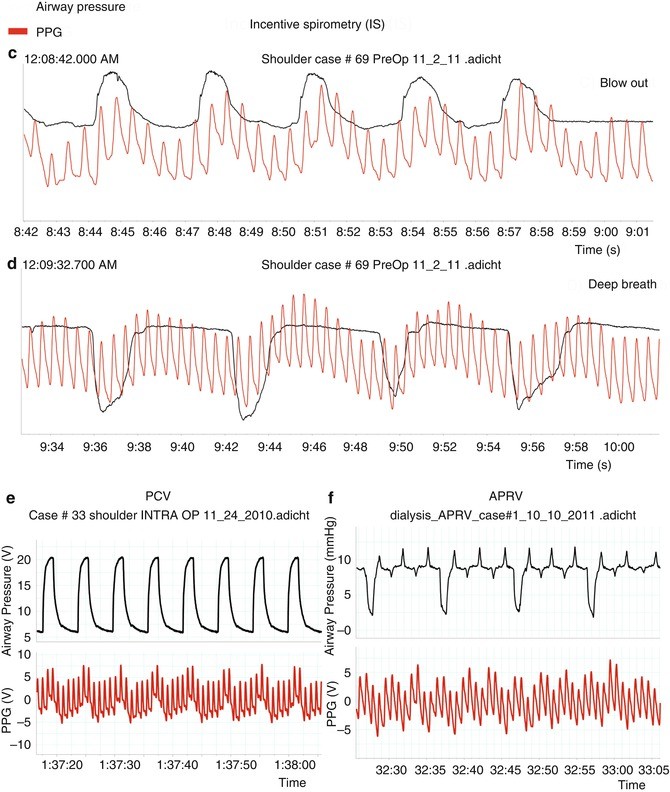 Photoplethysmography: Analysis of the Pulse Oximeter Waveform | SpringerLink