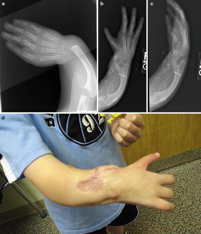 A CASE OF UNILATERAL TIBIAL HEMIMELIA WITH UNILATERAL RADIAL CLUB