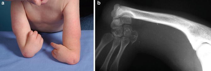 Radial Longitudinal Deficiency (Radial Club Hand)