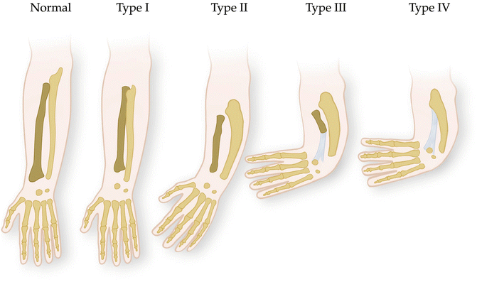 Ulnar Longitudinal Deficiency (Ulnar Club Hand)