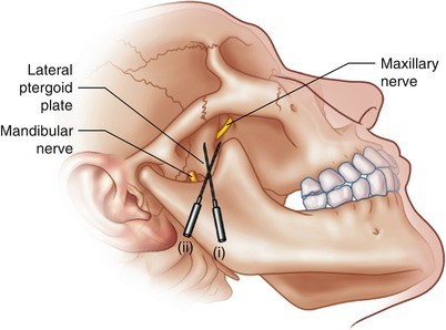 The Mandibular Nerve Block Anatomy The mandibular