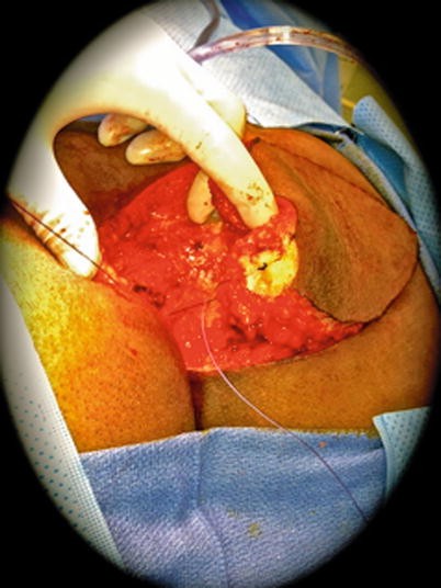 PILONIDAL DISEASE — General Surgery Langley