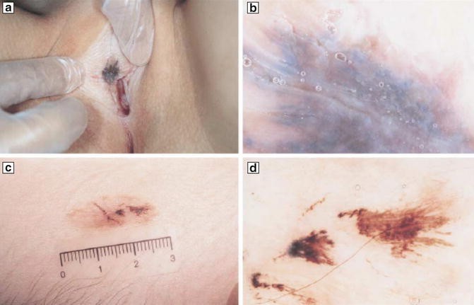 melanotan new moles PDF] Changes of melanocytic lesions inducedby Melanotan injections and sun  bed use ina teenage patient with FAMMM syndrome