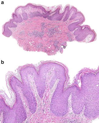 melanotic macule pathology outlines oral pigmented lesions: Clinicopathologic features and review of the literature Pathology Outlines Vulvovaginal melanocytic lesions: a review