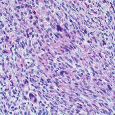 Malignant Peripheral Nerve Sheath Tumors