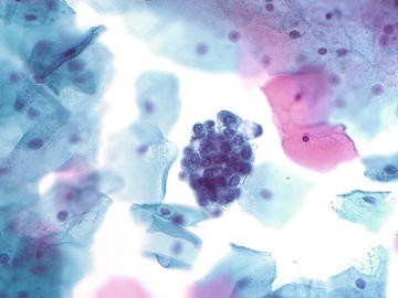 Cytology of Endometrial Cells and Lesions | SpringerLink