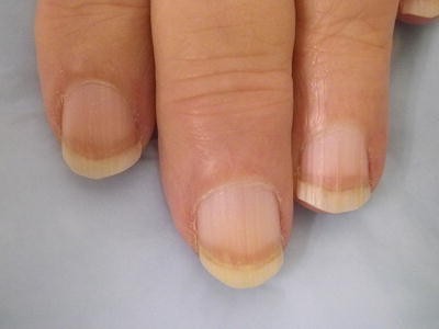 Nail Diseases Among Renal Patients Springerlink