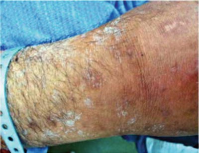 Uremic Frost-kidney-Failure-Causes-Diagnosis-Treatment-Homeopathic-Allopathic | Dr Qaisar Ahmed MD, DHMS