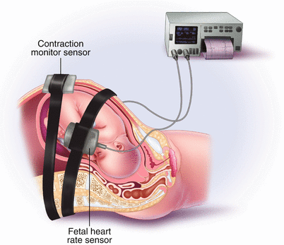 Fetal Heart Rate Monitoring | SpringerLink