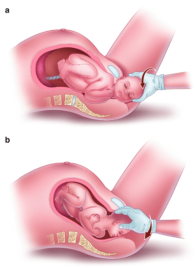 Shoulder Dystocia Management | SpringerLink