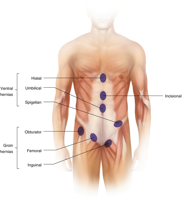 Manual Reduction of Abdominal Hernia