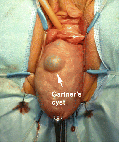 Vaginal Cysts and Masses