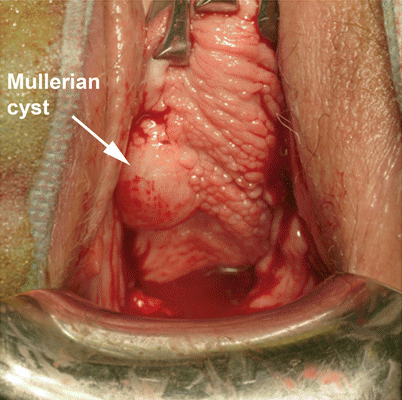 Vaginal Cysts and Masses