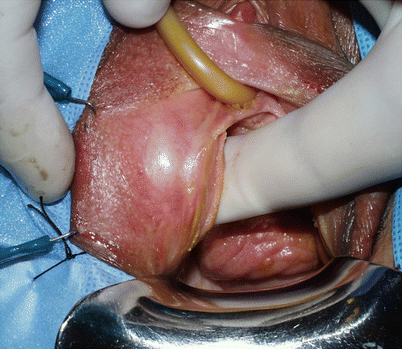 Ovarian Cysts Vaginal Cysts and Masses | Ovarian Cysts-Types-Causes-Symptoms-Best treatment | Homeopathic | Best Homeopathic Doctor in Pakistan | Dr Qaisar Ahmed MD, DHMS