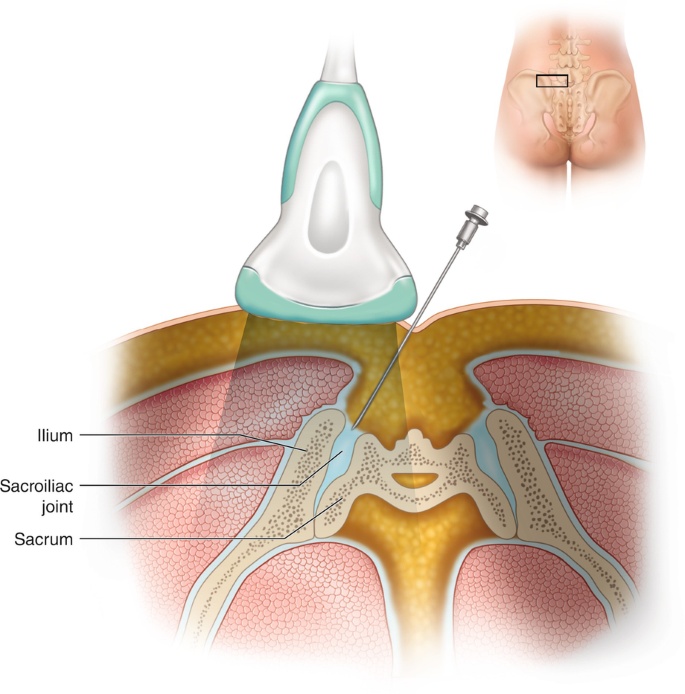 sacroiliac joint injection