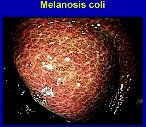 melanotan 2 side effects men Changes in Oral Mucosa Associated with Melanotan II Injections: A Case  Report