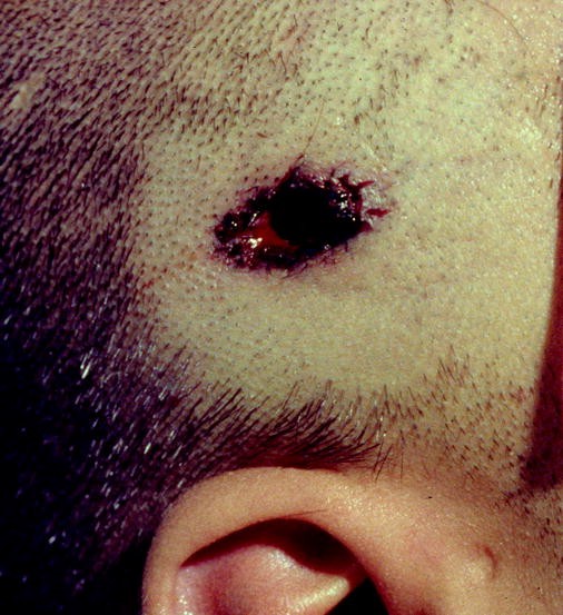Gunshot Wound Deaths | SpringerLink