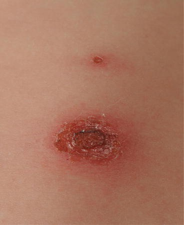 cigarette burn marks on skin Skin Conditions Mimicking Pediatric Inflicted Injury