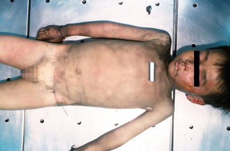 autopsy kid 