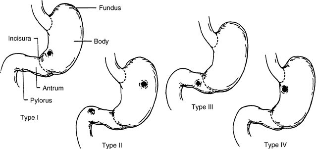 gastric ulcer types