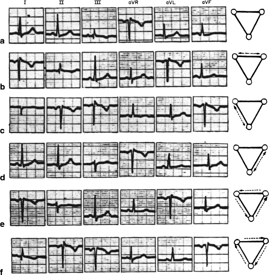 Figure 1 from Counterclockwise and Clockwise Rotation of QRS Transitional  Zone: Prospective Correlates of Change and Time‐Varying Associations With  Cardiovascular Outcomes