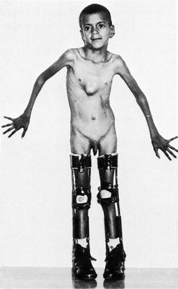 marfan nude  Marfan syndrome: Report of two cases with review of literature