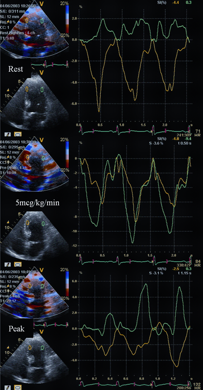 Stress Echocardiography | Springer Nature Link (formerly SpringerLink)