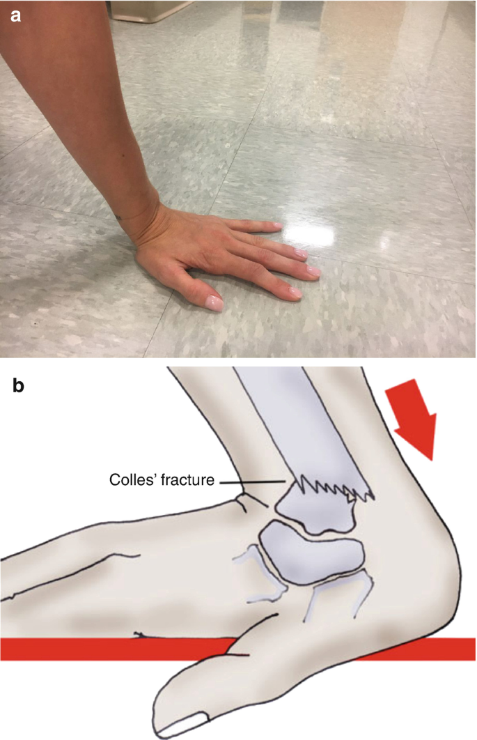 Distal Radius Springerlink