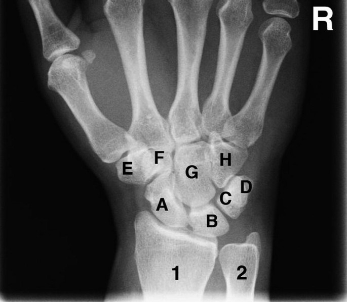 File:Pronation and supination.jpg - Wikipedia