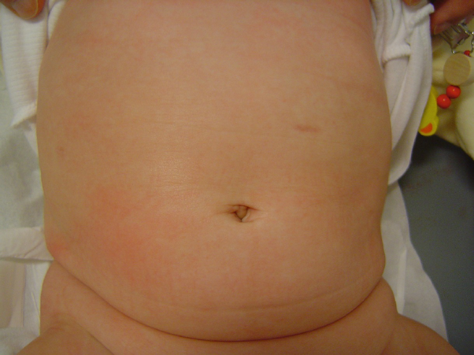Laparoscopic Pyloromyotomy | SpringerLink