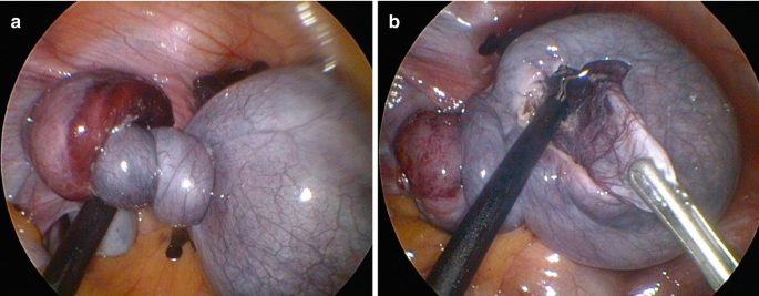 Laparoscopic Management of Ovarian Cysts | Springer Nature Link (formerly  SpringerLink), image size:685x267