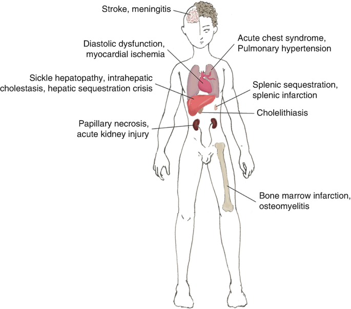 Sickle Cell Disease and ICU