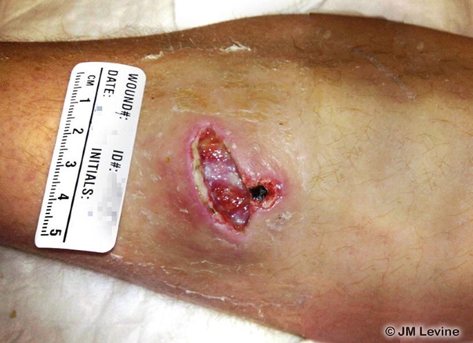 Pressure Injury and Chronic Wounds