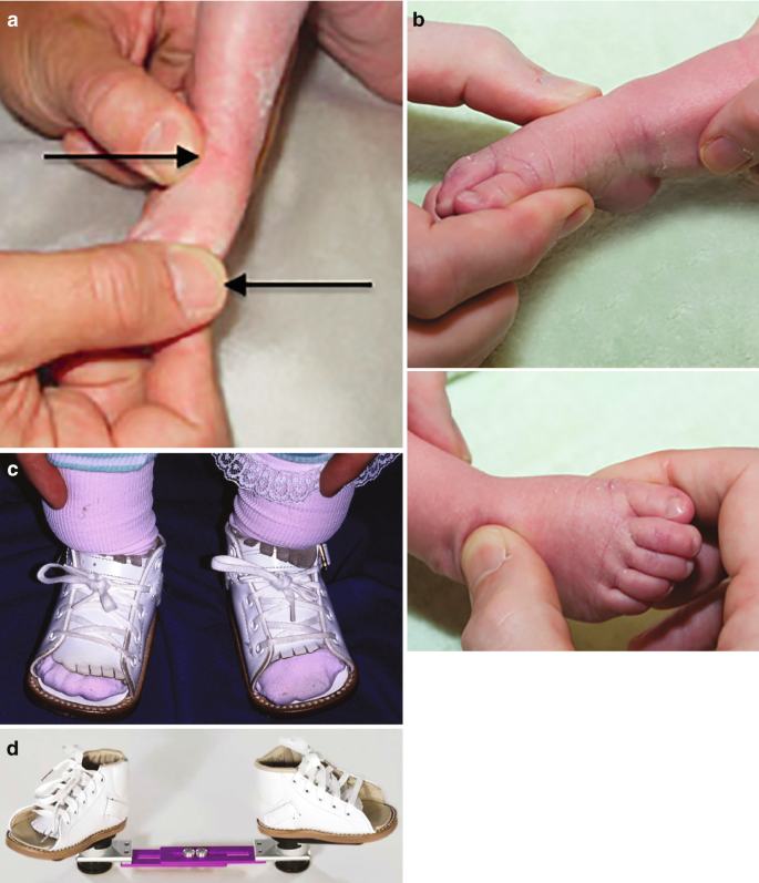 Hammertoe Correction (Precare)